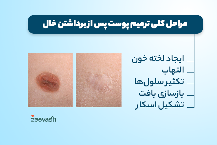 مراحل کلی ترمیم پوست بعد از برداشتن خال